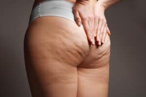 Cellulite &ndash; das leidige Thema, das viele Frauen betrifft. Diese unsch&ouml;ne Dellenbildung auf der Haut, oft als "Orangenhaut" bezeichnet, ist f&uuml;r viele ein &Auml;rgernis.