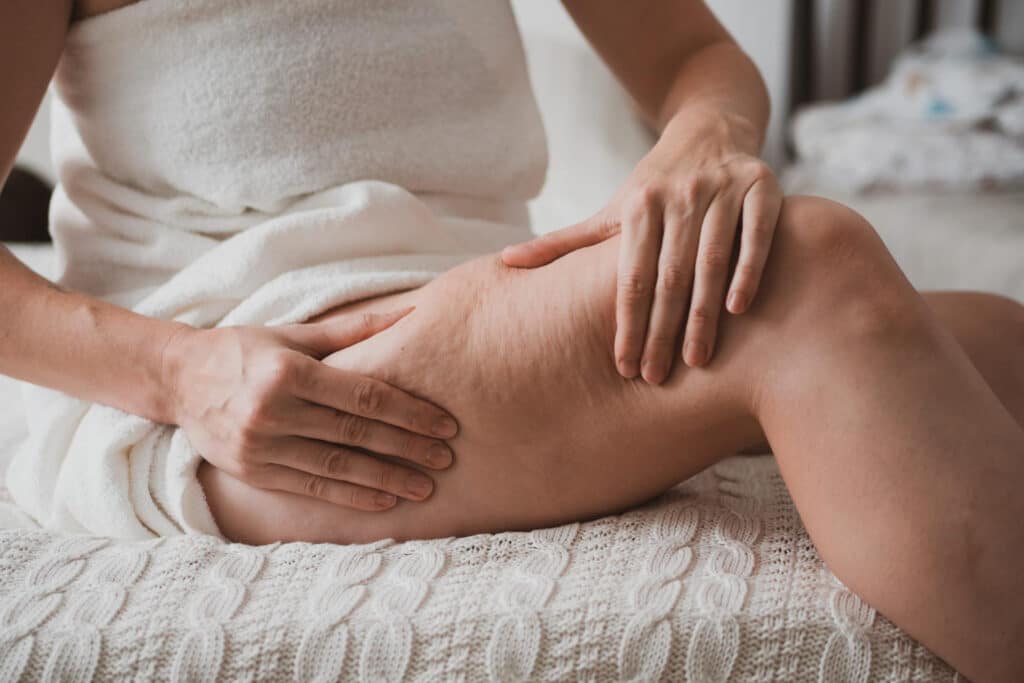 Erfahre, was Cellulite ist, warum sie entsteht und wie du sie mit Ern&auml;hrung, Sport und gezielter Pflege effektiv reduzieren kannst.